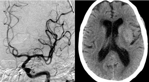Exemple. Trombectomia mecànica de rescat en el ictus isquèmic